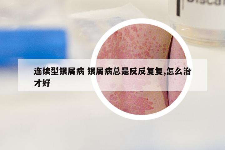 连续型银屑病 银屑病总是反反复复,怎么治才好