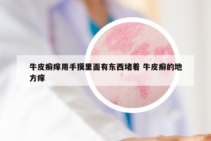 牛皮癣痒用手摸里面有东西堵着 牛皮癣的地方痒