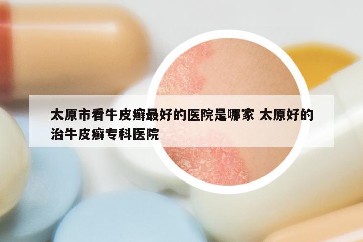 太原市看牛皮癣最好的医院是哪家 太原好的治牛皮癣专科医院