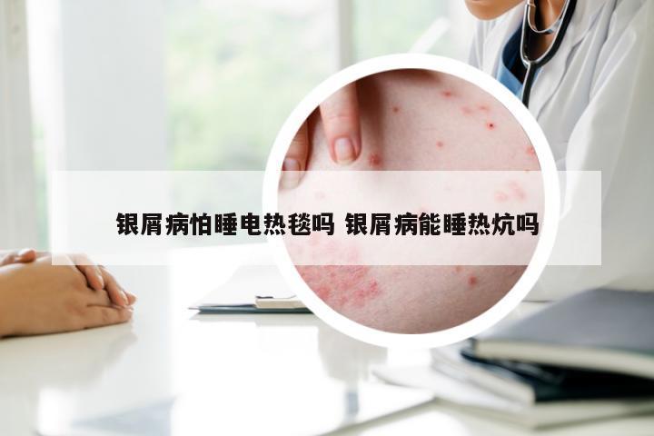 银屑病怕睡电热毯吗 银屑病能睡热炕吗