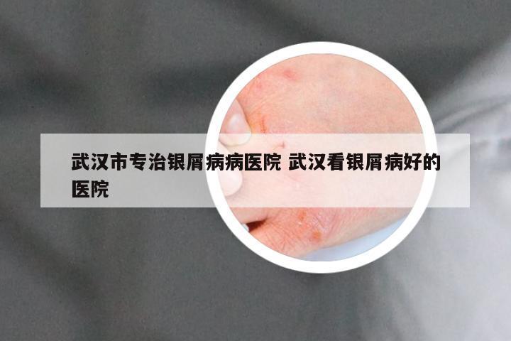 武汉市专治银屑病病医院 武汉看银屑病好的医院
