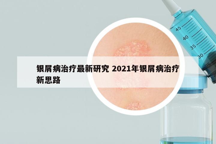 银屑病治疗最新研究 2021年银屑病治疗新思路