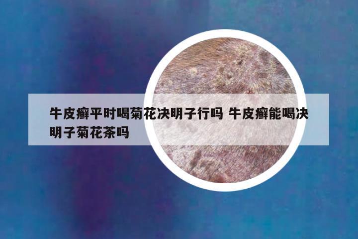 牛皮癣平时喝菊花决明子行吗 牛皮癣能喝决明子菊花茶吗