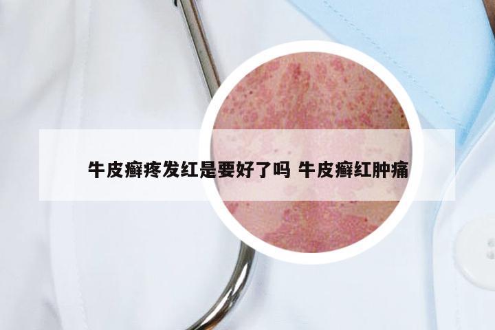 牛皮癣疼发红是要好了吗 牛皮癣红肿痛
