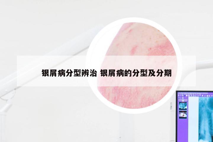 银屑病分型辨治 银屑病的分型及分期