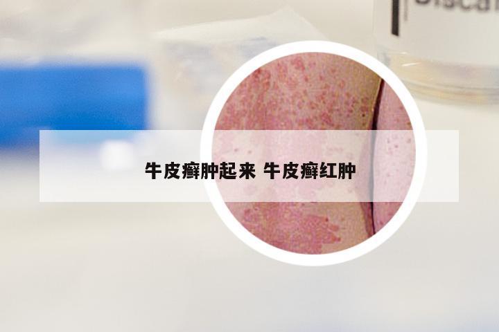 牛皮癣肿起来 牛皮癣红肿