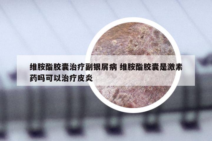 维胺酯胶囊治疗副银屑病 维胺酯胶囊是激素药吗可以治疗皮炎