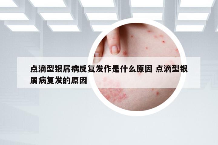 点滴型银屑病反复发作是什么原因 点滴型银屑病复发的原因