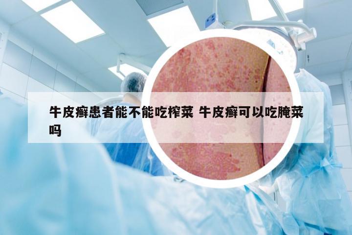 牛皮癣患者能不能吃榨菜 牛皮癣可以吃腌菜吗