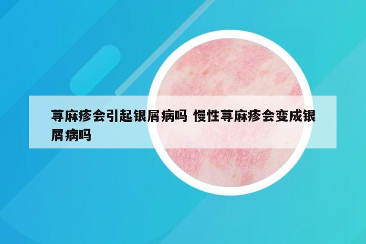 荨麻疹会引起银屑病吗 慢性荨麻疹会变成银屑病吗