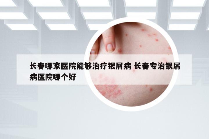 长春哪家医院能够治疗银屑病 长春专治银屑病医院哪个好