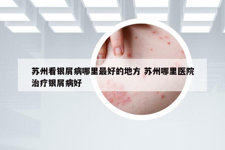 苏州看银屑病哪里最好的地方 苏州哪里医院治疗银屑病好