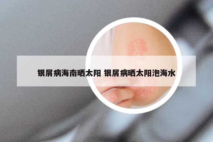 银屑病海南晒太阳 银屑病晒太阳泡海水