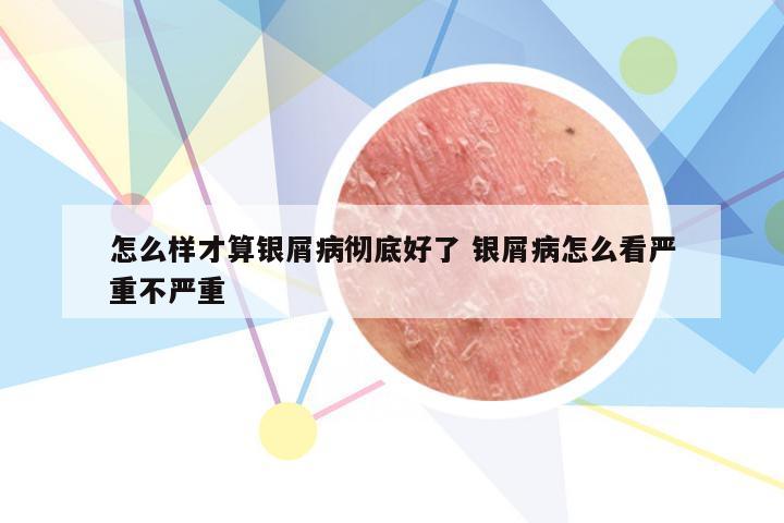 怎么样才算银屑病彻底好了 银屑病怎么看严重不严重