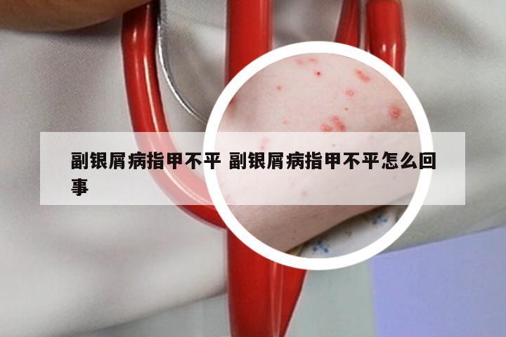 副银屑病指甲不平 副银屑病指甲不平怎么回事