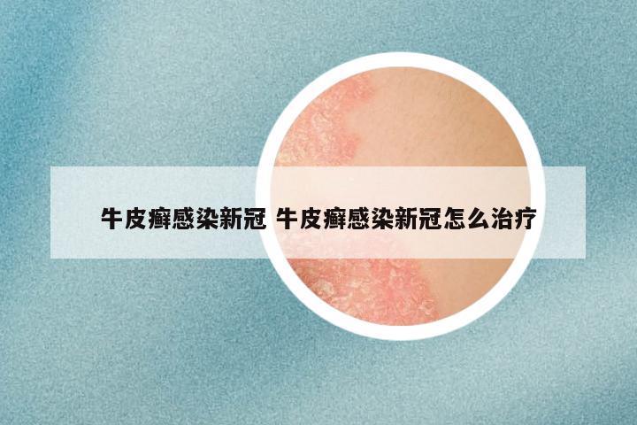 牛皮癣感染新冠 牛皮癣感染新冠怎么治疗