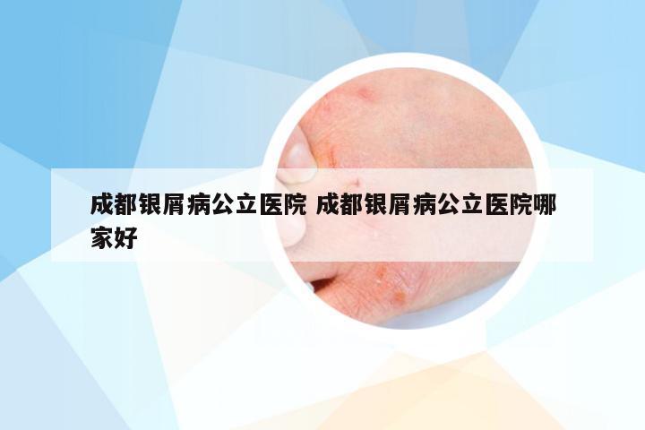 成都银屑病公立医院 成都银屑病公立医院哪家好