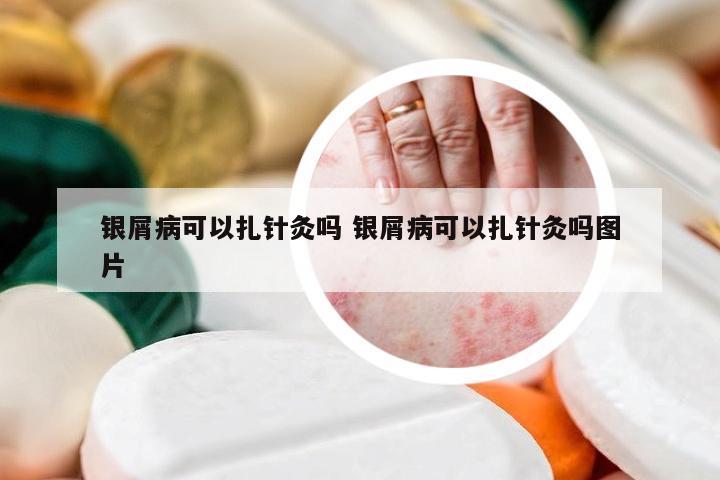 银屑病可以扎针灸吗 银屑病可以扎针灸吗图片