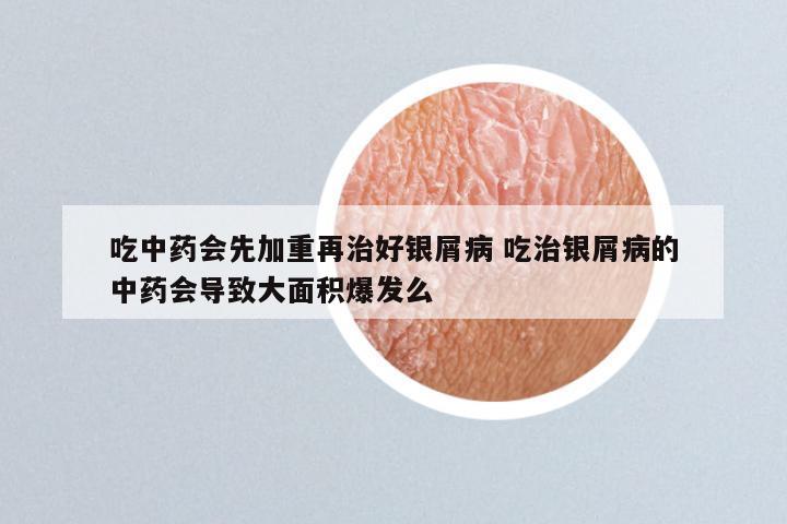 吃中药会先加重再治好银屑病 吃治银屑病的中药会导致大面积爆发么
