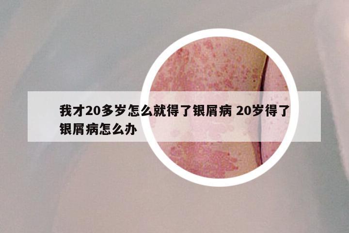 我才20多岁怎么就得了银屑病 20岁得了银屑病怎么办