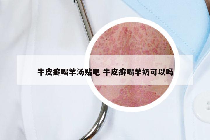 牛皮癣喝羊汤贴吧 牛皮癣喝羊奶可以吗