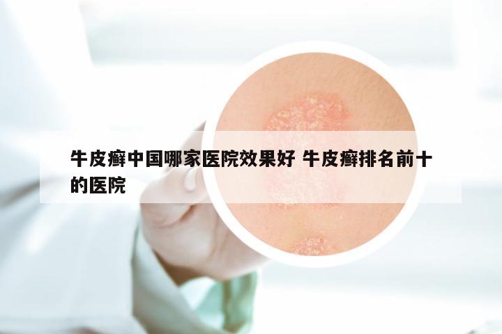 牛皮癣中国哪家医院效果好 牛皮癣排名前十的医院