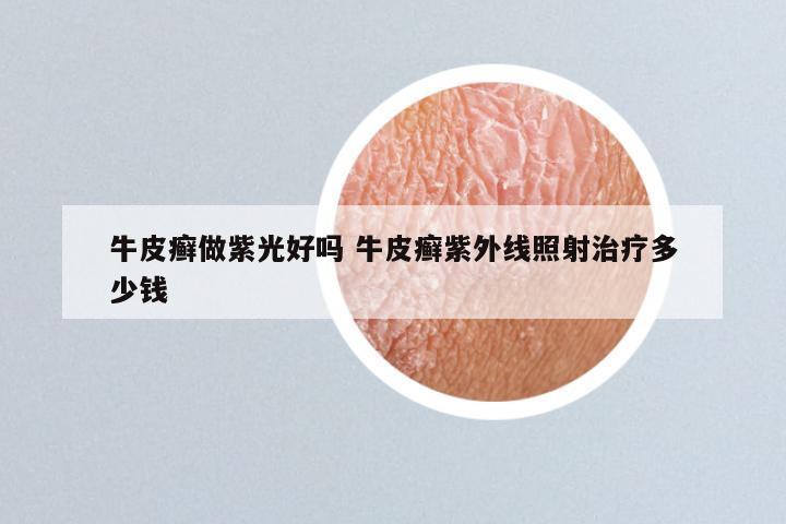 牛皮癣做紫光好吗 牛皮癣紫外线照射治疗多少钱