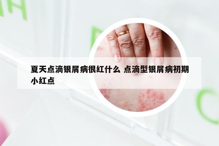 夏天点滴银屑病很红什么 点滴型银屑病初期小红点