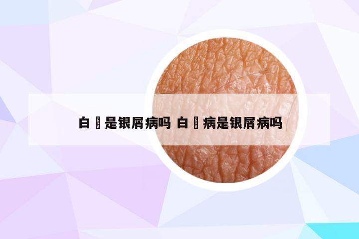 白疕是银屑病吗 白疕病是银屑病吗