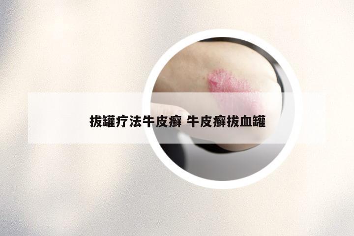 拔罐疗法牛皮癣 牛皮癣拔血罐