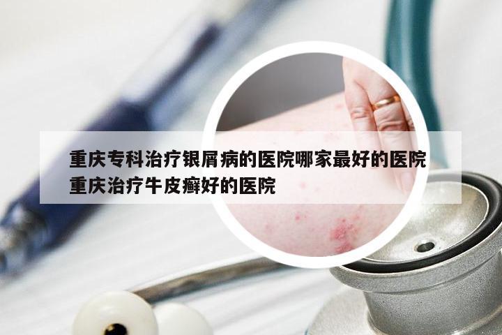 重庆专科治疗银屑病的医院哪家最好的医院 重庆治疗牛皮癣好的医院