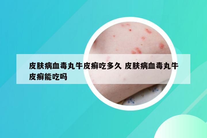 皮肤病血毒丸牛皮癣吃多久 皮肤病血毒丸牛皮癣能吃吗