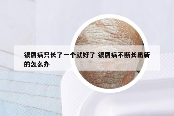 银屑病只长了一个就好了 银屑病不断长出新的怎么办