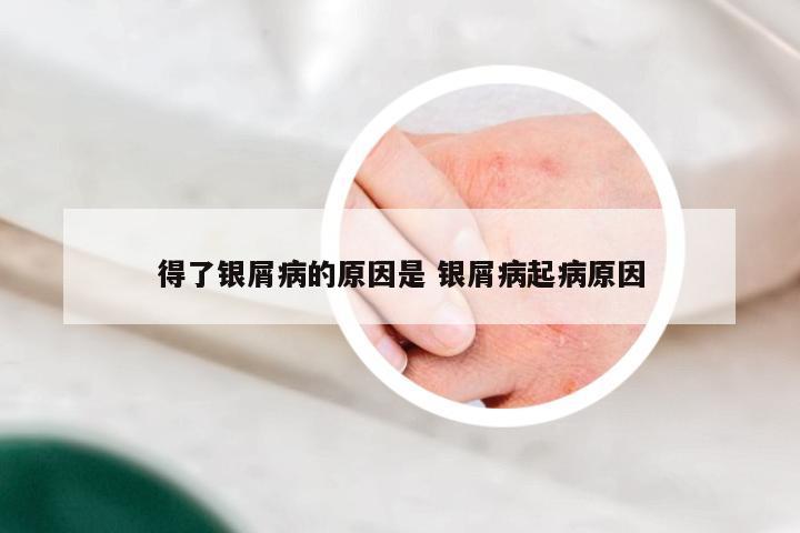 得了银屑病的原因是 银屑病起病原因