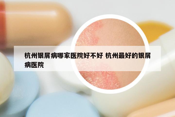 杭州银屑病哪家医院好不好 杭州最好的银屑病医院