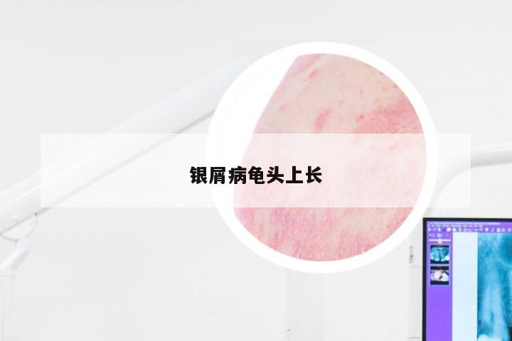 银屑病龟头上长
