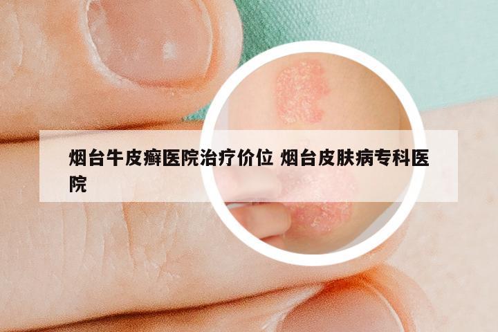 烟台牛皮癣医院治疗价位 烟台皮肤病专科医院