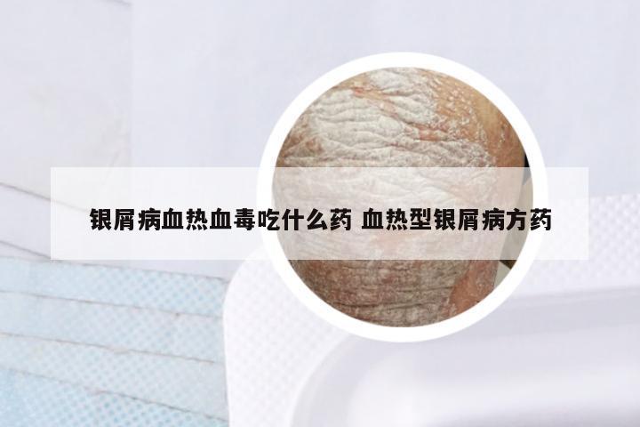 银屑病血热血毒吃什么药 血热型银屑病方药