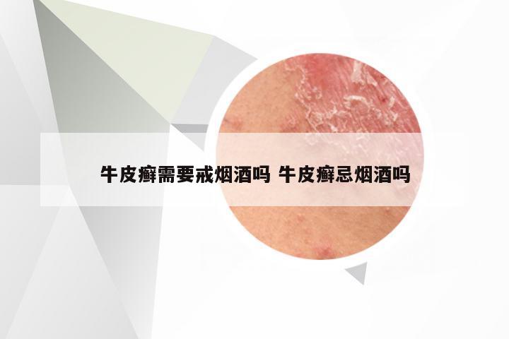牛皮癣需要戒烟酒吗 牛皮癣忌烟酒吗