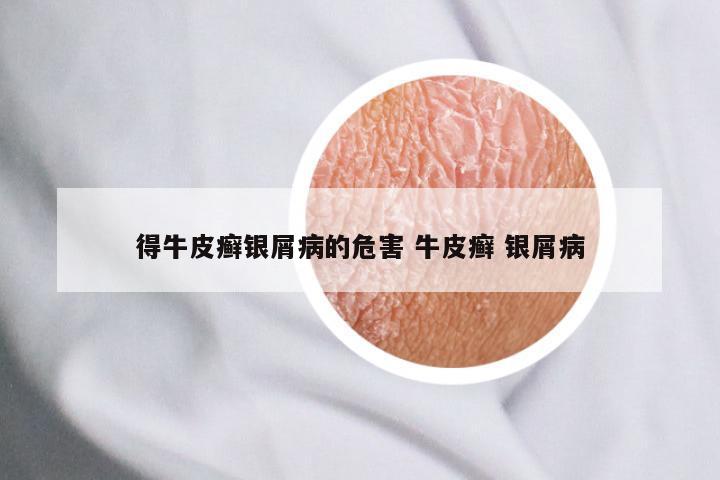 得牛皮癣银屑病的危害 牛皮癣 银屑病