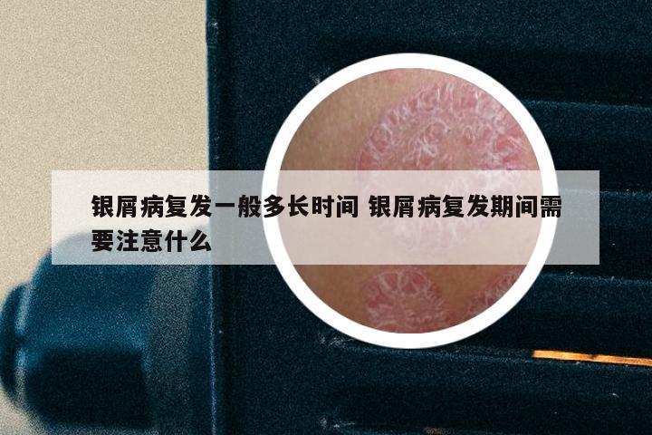 银屑病复发一般多长时间 银屑病复发期间需要注意什么