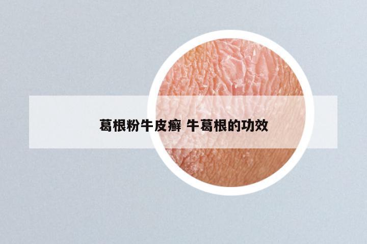 葛根粉牛皮癣 牛葛根的功效