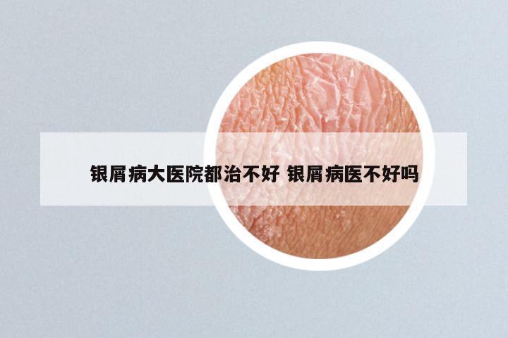 银屑病大医院都治不好 银屑病医不好吗