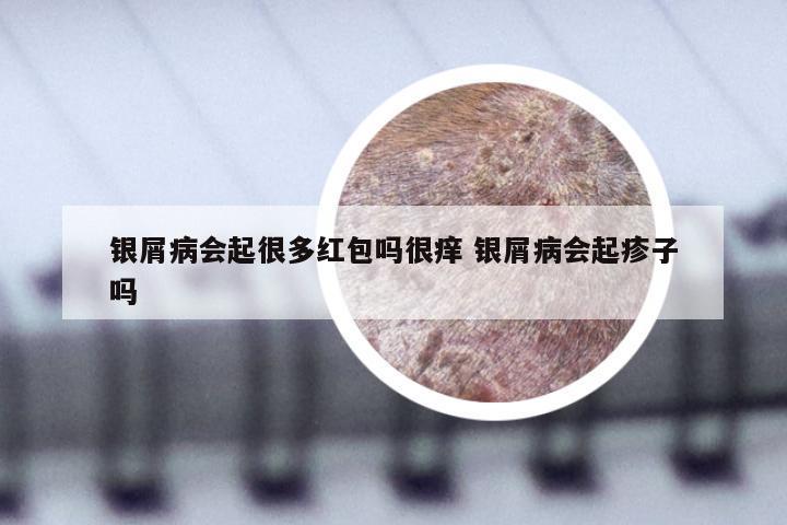 银屑病会起很多红包吗很痒 银屑病会起疹子吗