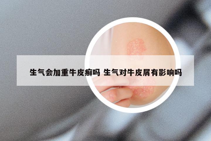 生气会加重牛皮癣吗 生气对牛皮屑有影响吗