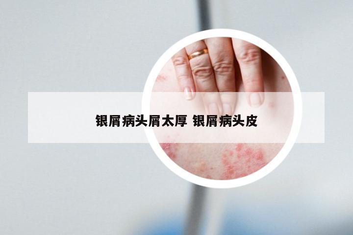 银屑病头屑太厚 银屑病头皮