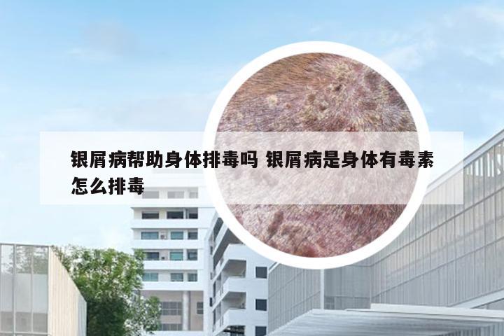 银屑病帮助身体排毒吗 银屑病是身体有毒素怎么排毒