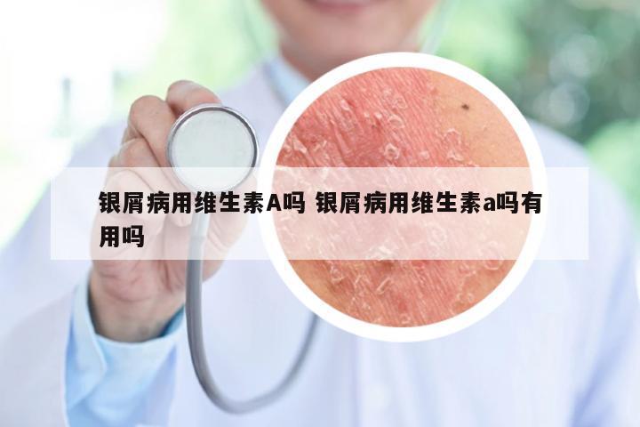银屑病用维生素A吗 银屑病用维生素a吗有用吗