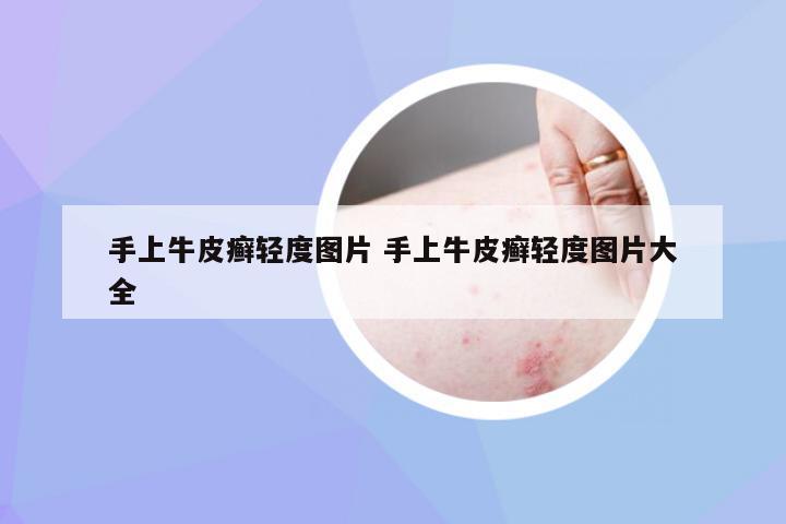 手上牛皮癣轻度图片 手上牛皮癣轻度图片大全