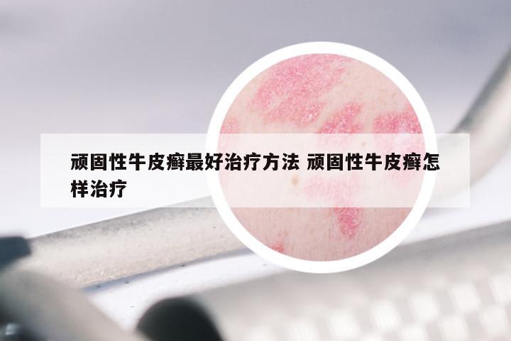 顽固性牛皮癣最好治疗方法 顽固性牛皮癣怎样治疗